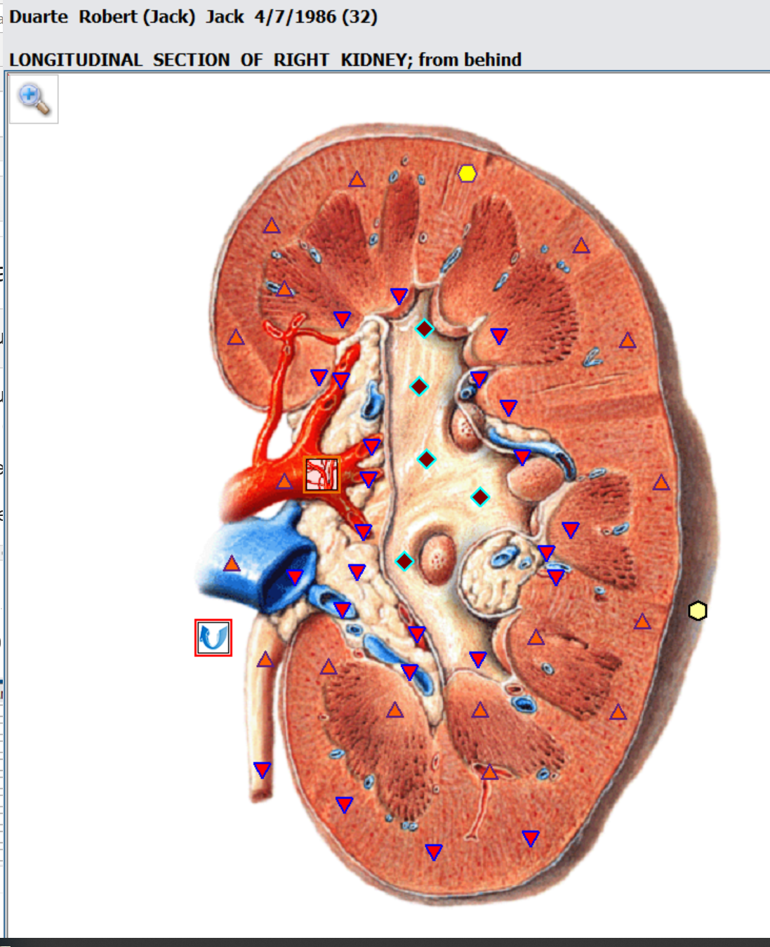 Kidney Stones Prevention NutriMedical